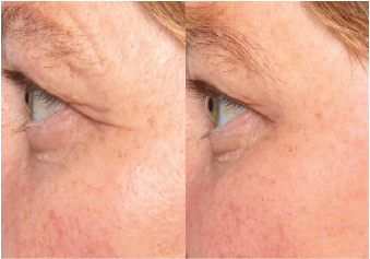 Improve aging skin appearance with NunaSkin, a revolutionary medical device for home use